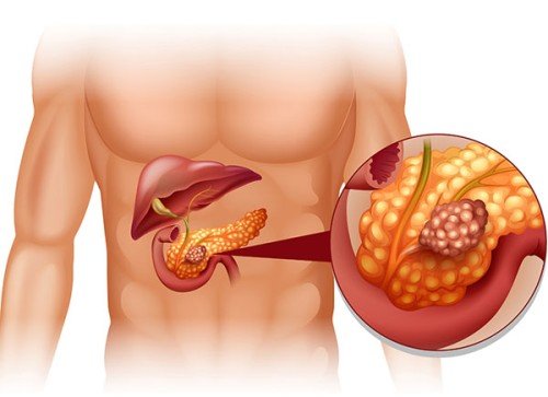 Pancreatic Diseases Overview