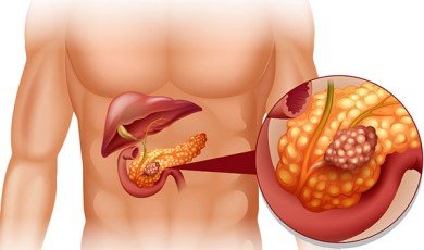 Pancreatic Diseases Overview