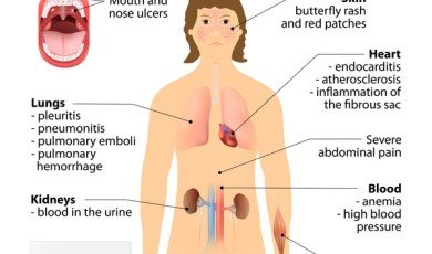 Unveiling the Mysteries of Lupus: Understanding an Invisible Disease