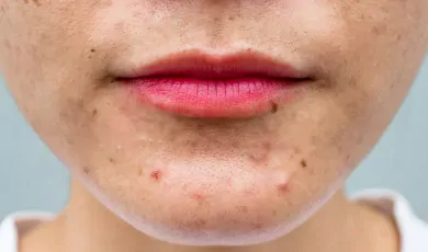 The causes of acne, as well as some treatment options that can help alleviate the symptoms