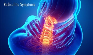 Understanding Radiculitis: Causes, Symptoms, and Treatment Options