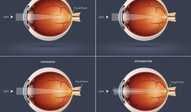 Refractive Errors